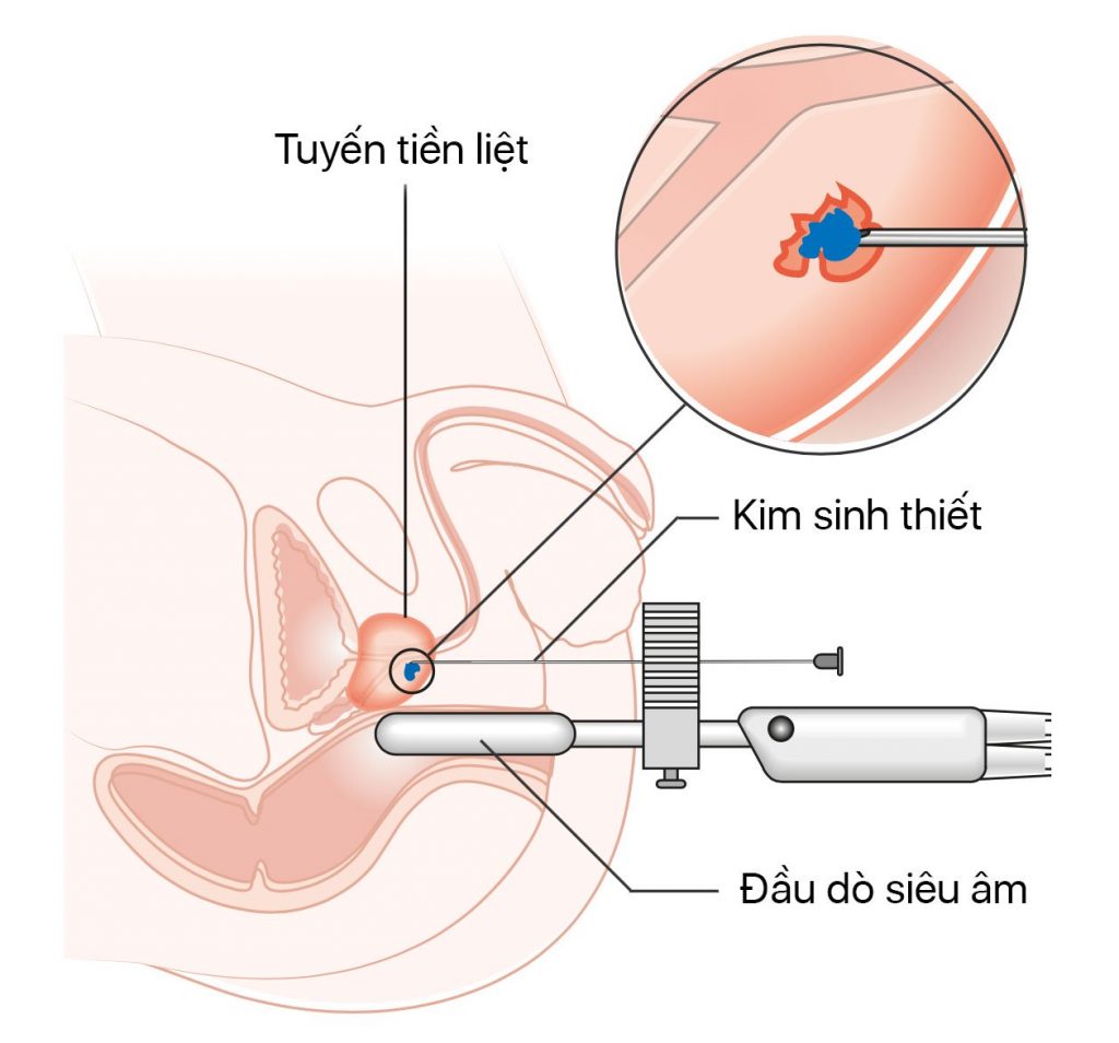 Sinh thiết lỏng ctDNA phát hiện sớm 9 loại ung thư thường gặp